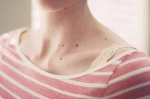 شناخت انواع خال با توجه به عکس یا چگونه یک خال معمولی را از خال سرطانی تشخیص بدهیم؟
