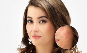 عمل سابسیژن برای رفع اسکار و جای جوش چگونه انجام می‌شود؟