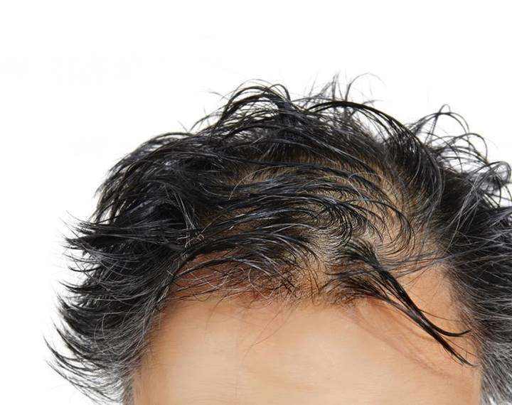 عوارض کاشت مو چیست (جای زخم، درد، ورم سر، عفونت و ...)