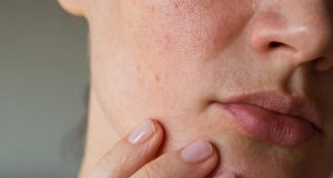 منافذ باز پوستی یا پوست پرتقالی چیست و چگونه درمان میشود؟